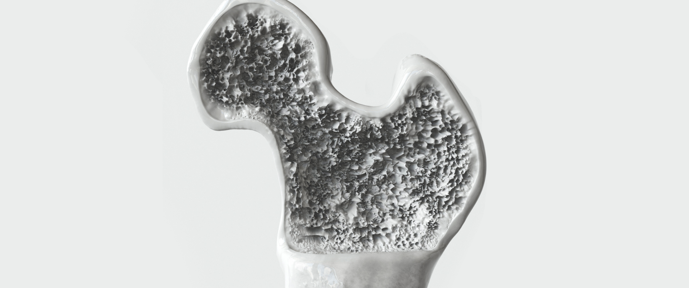 Illustration of osteoporotic bone structure